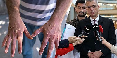 Sağlık Bakanı Memişoğlu’ndan ‘Maymun Çiçeği’ açıklaması: Alarmdayız
